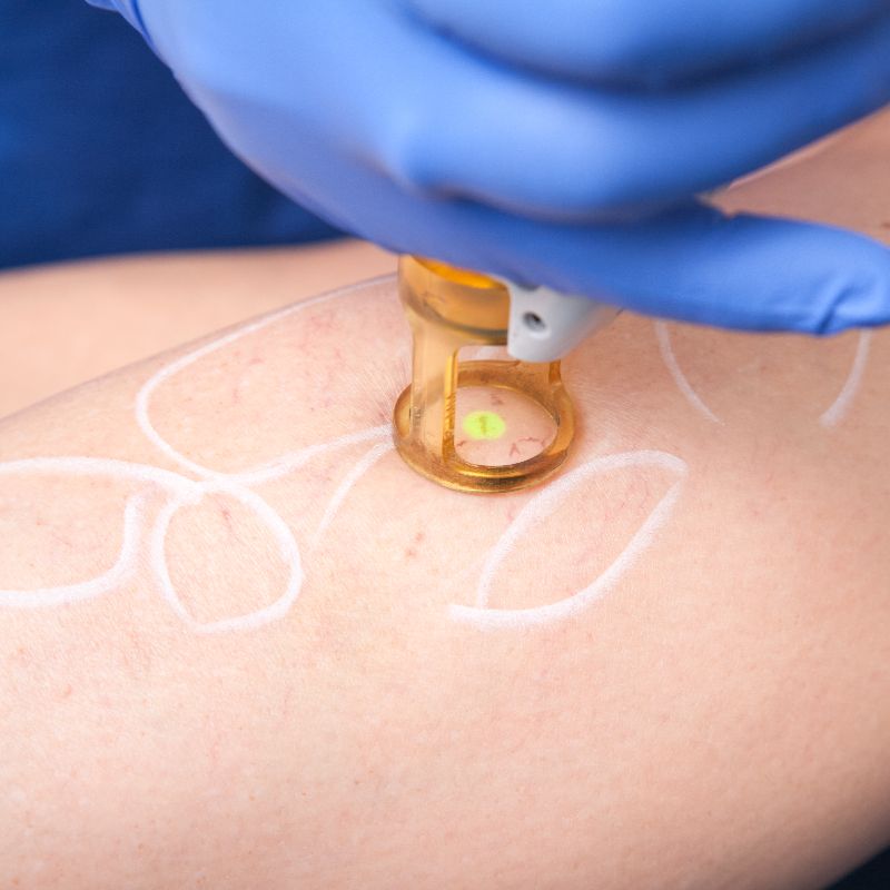 tratamiento de eliminación láser vascular en Leganés