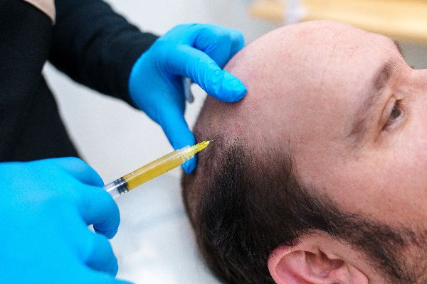 alopecia androgénica